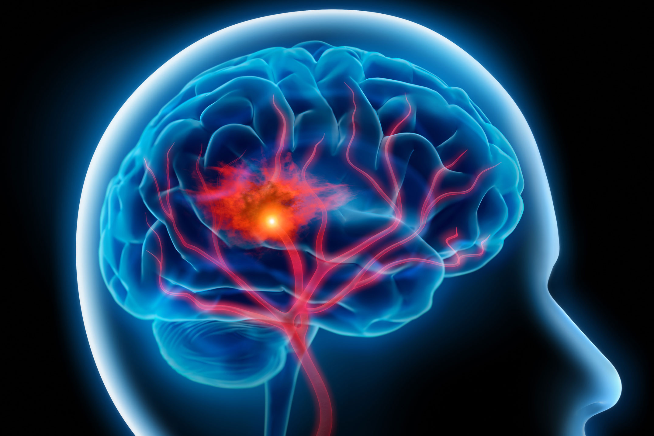 ¿Sabes Cuáles Son Los Signos De Un Ictus O Accidente Cerebrovascular ...