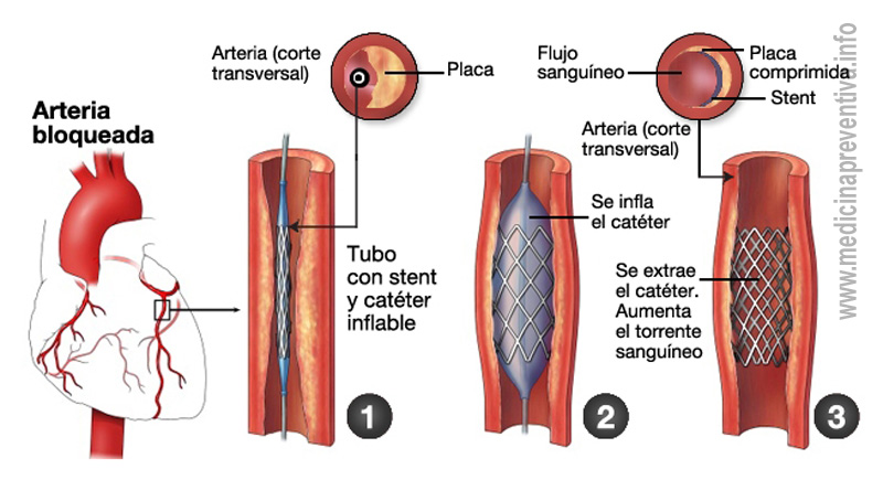 Los Stents Recubiertos Con Medicamentos Favorecen La Supervivencia Los Stents Recubiertos Con Medicamentos Favorecen La Supervivencia